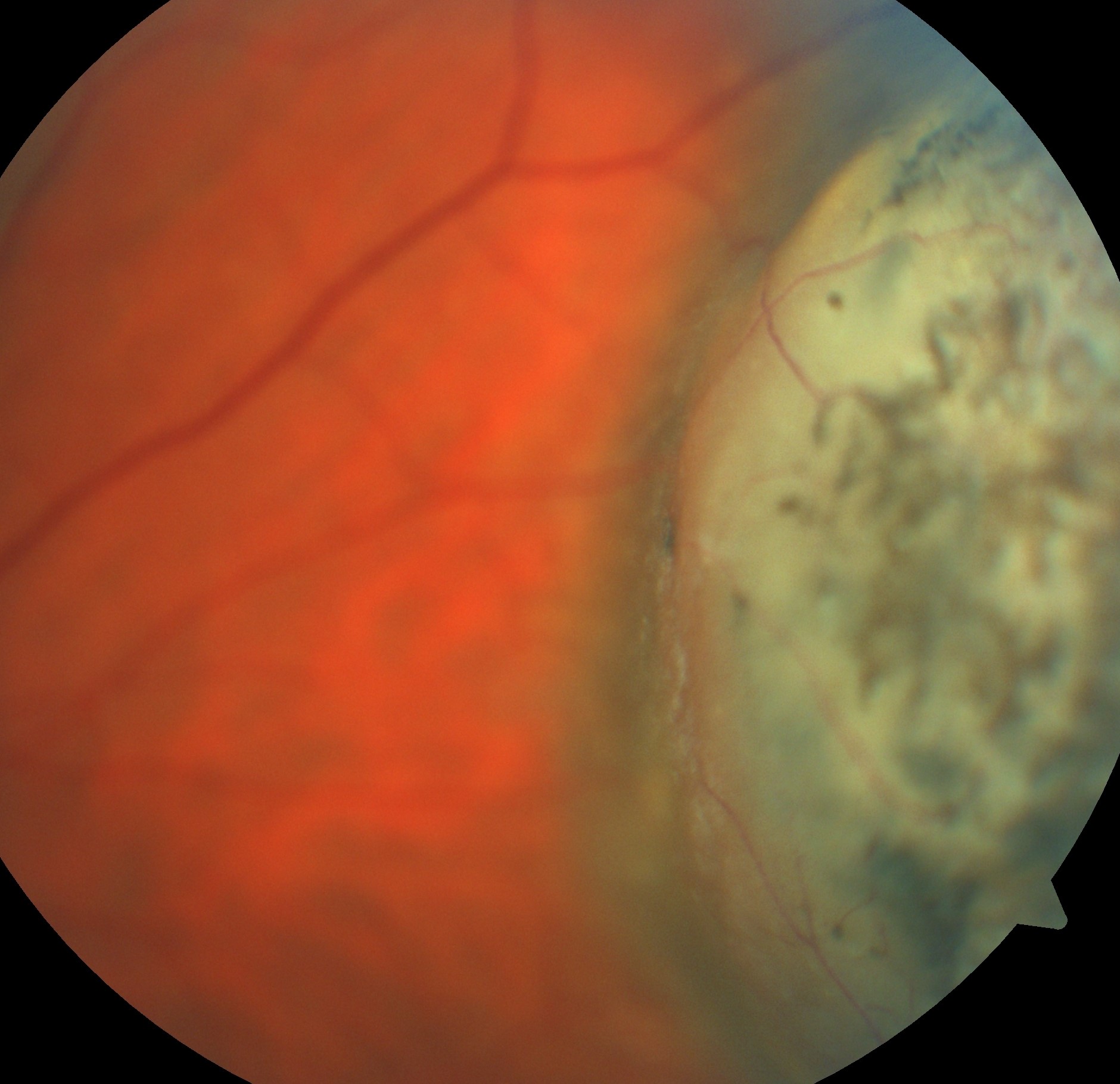 Read more about the article Eye Cancer Found On Routine Exam