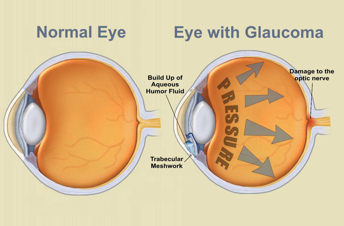 Read more about the article Glaucoma Awareness Month