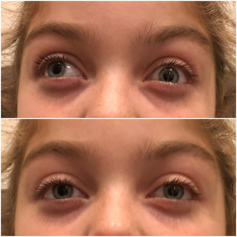 NonSurgical Correction of Exotropia Dr. Claudia Lee Optometrist